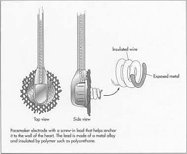 The first pacemaker using integrated circuits was created