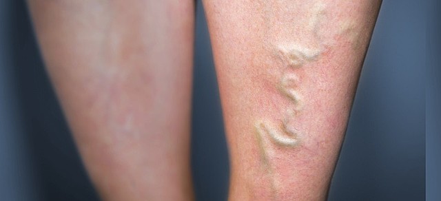 Antonina's Leg Infection