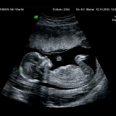 Timeline: Prenatal Timeline