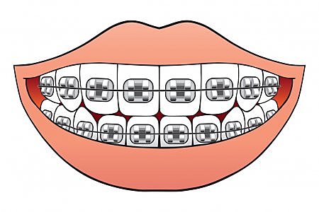 Poné frenillos de mi dientes la primera vez.