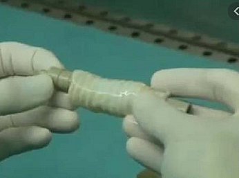 Transplante Sintetico - Suecia