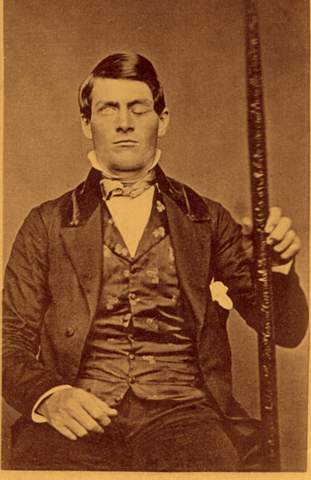 Phineas Cage suffers brain damage in an explosion