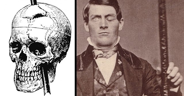 Caso Phineas Gage