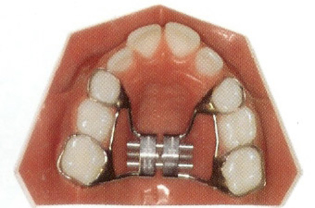 Retainer/Palate Expander