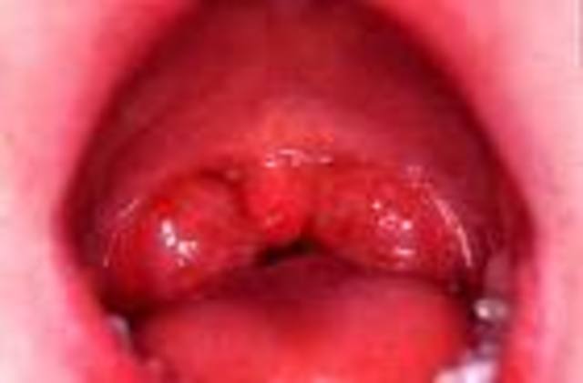 Tonsils