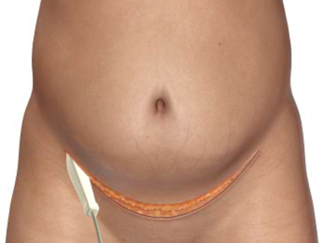 Incision made, 8:08 am