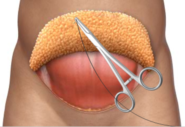 Incision is sealed... 8:19 am