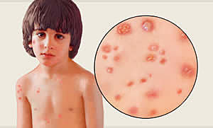 Erradicación de la viruela