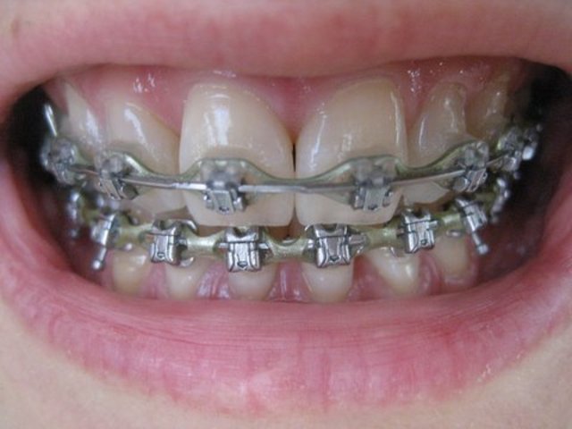 Braces