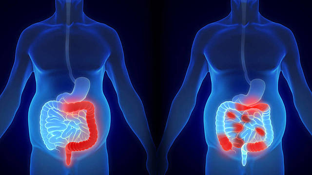 ENFERMEDADES SISTEMA DIGESTIVO