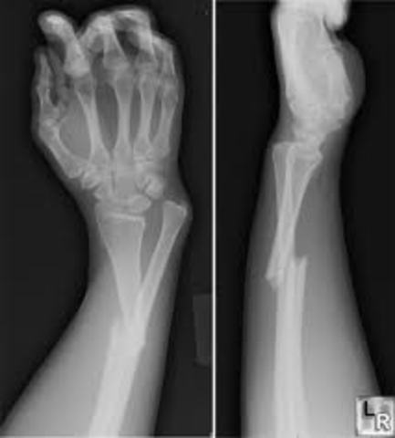 Bone Fracture
