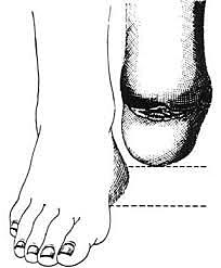 Ankle Amputation/Prosthetic