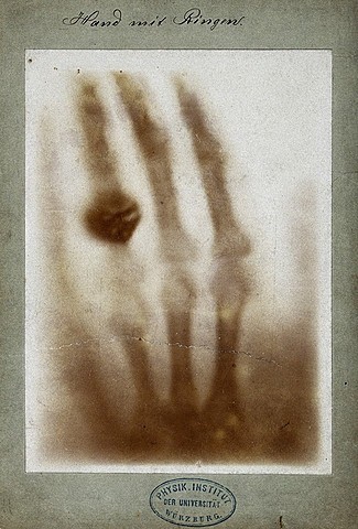 First human X-ray