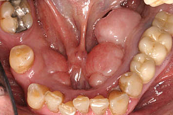 Cirugía de torus palatino