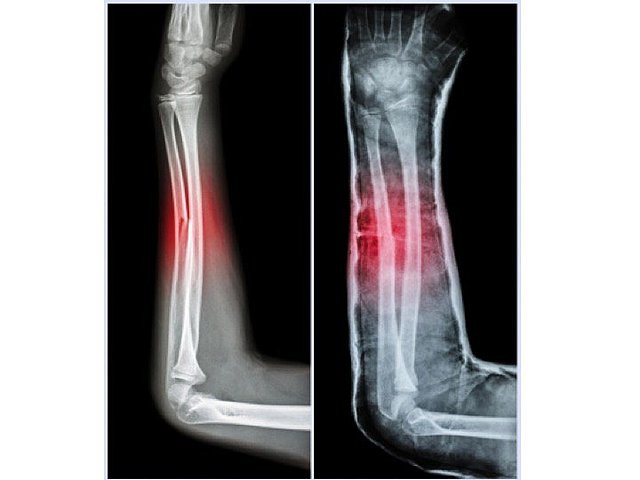 Breaking my arm the first time.