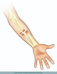 Breaking my arm the fifth time