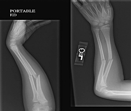 Breaking my arm the sixth time