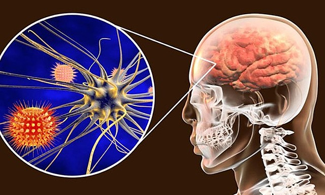 he died of meningitis