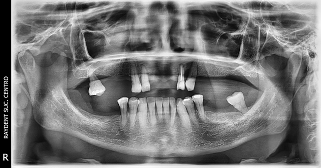 Radiografía panoramica