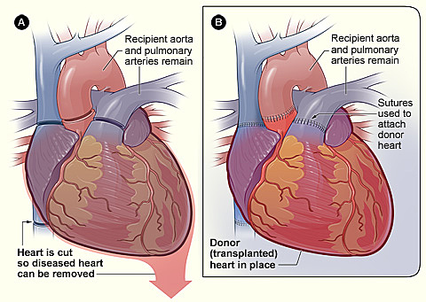 First Heart Transplant