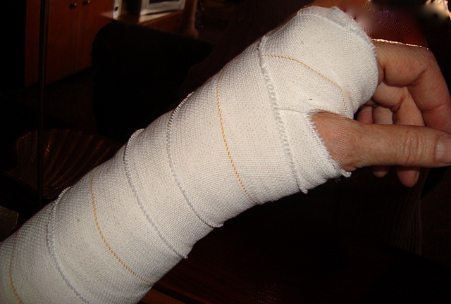 Fractura de meñique izquierdo montado patineta