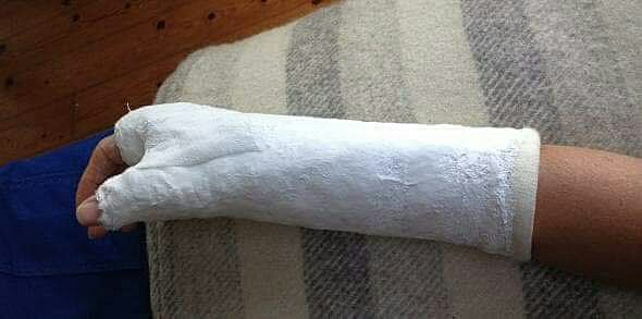 Fractura de Muñeca jugando futbol