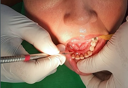 Fase 1 periodontal (curetaje cerrado)