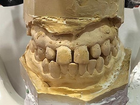 Toma de modelos y fotografías intraorales