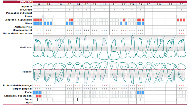 Sondeo periodontal