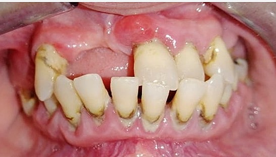 Fotografía intraoral