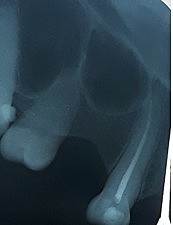 Endodoncia del OD 1.3