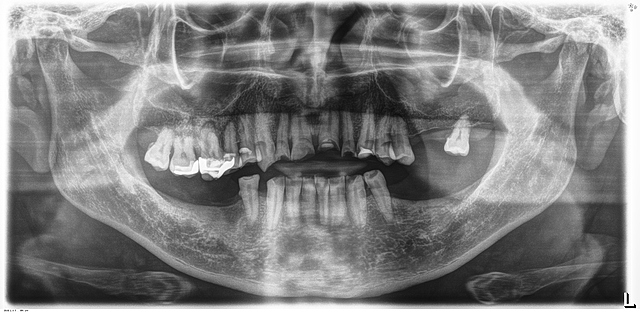 Análisis radiográfico, Modelos de estudio y análisis intraorales.