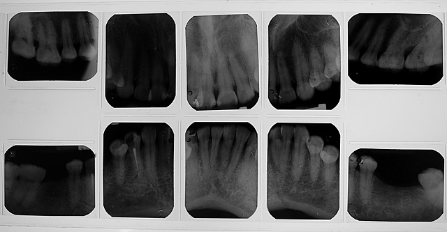 Análisis radiográfico