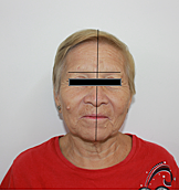 Análisis extraoral e intraoral