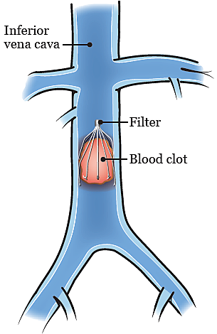Inferior Vena Cava Filter