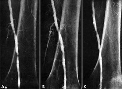Restoring Blood Flow