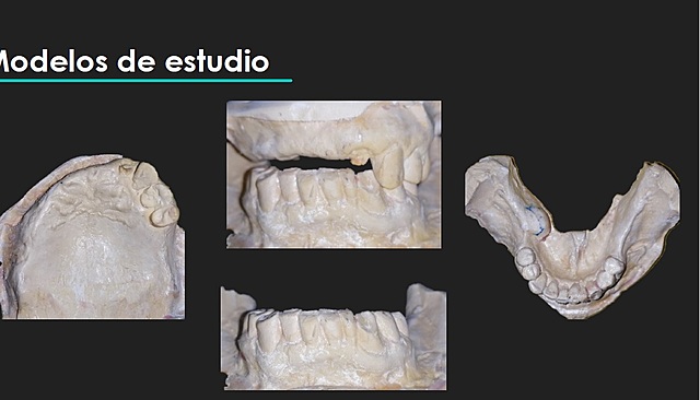 Modelos de estudio y fotografías intraorales