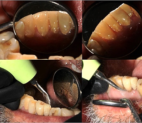Segunda cita Profilaxis