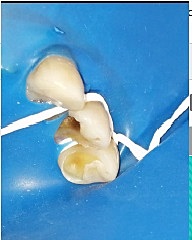 Tercera cita reconstrucción del órgano dentario 2.5