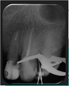 Cuarta cita desobturación y colocación de poste en OD 2.2 e inicio de endodoncia
