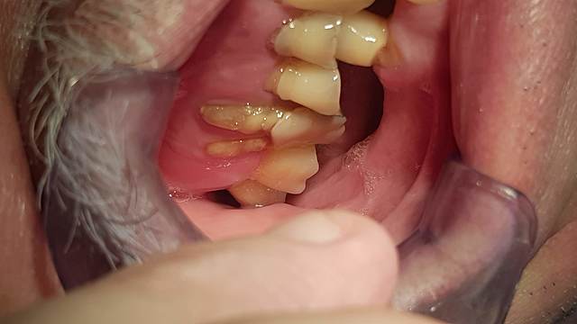 Extracción del Órgano dentario 1.6