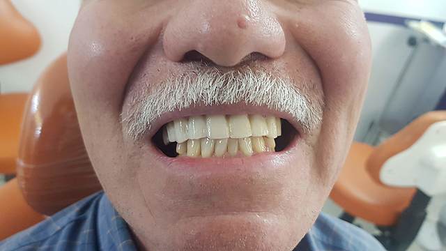 Ajuste de la oclusión, rebase y toma de modelos