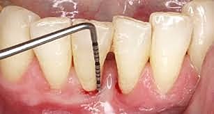 SONDEO Y PRUEBAS DE SENSIBILIDAD