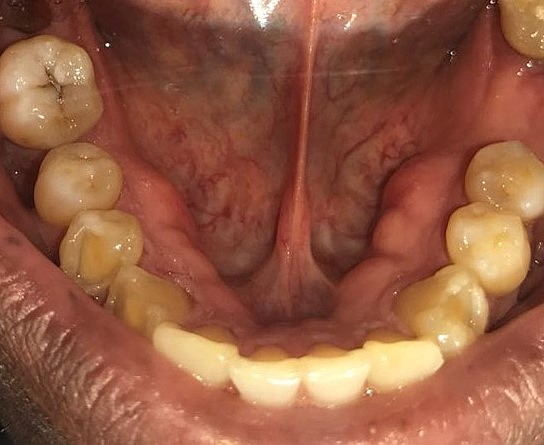 Fotografías intra orales