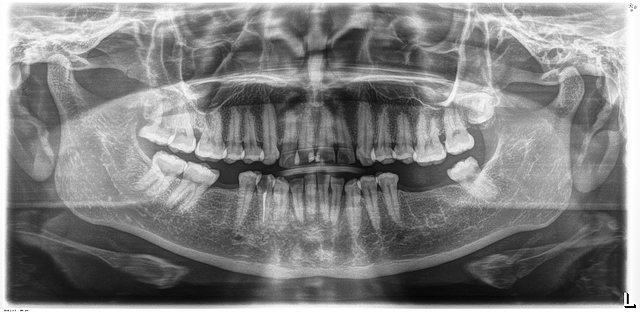 Análisis radiográfico