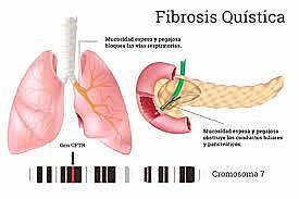 CURA DE LA FIBROSIS QUÍSTICA