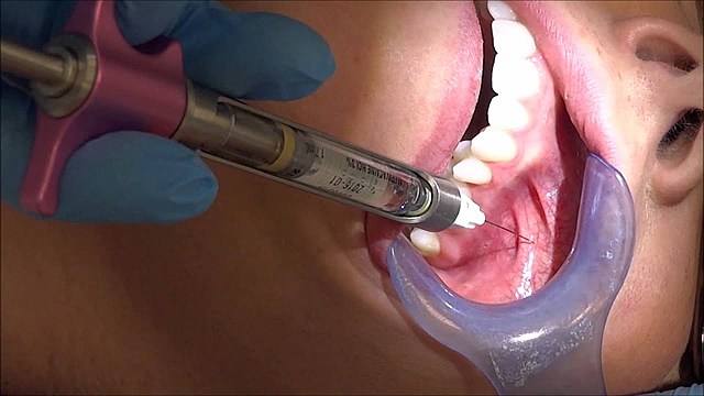 Local Anesthesia Administration and Unsupervised Practice of Dental Hygiene