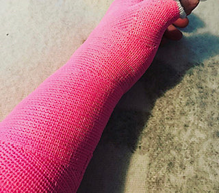 Breaking My Arm