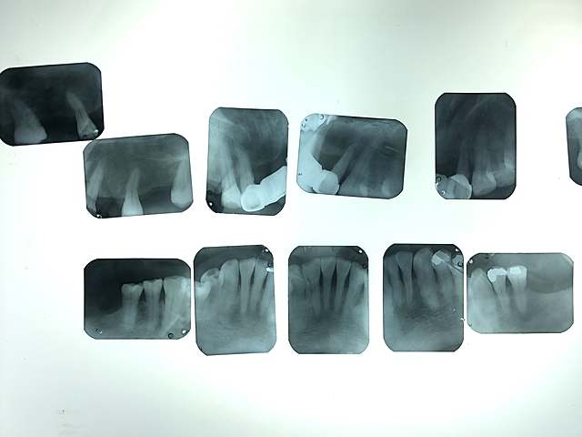 Análisis radiográfico