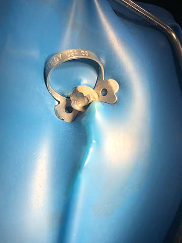 Inicio de endodoncia en el OD 3.4